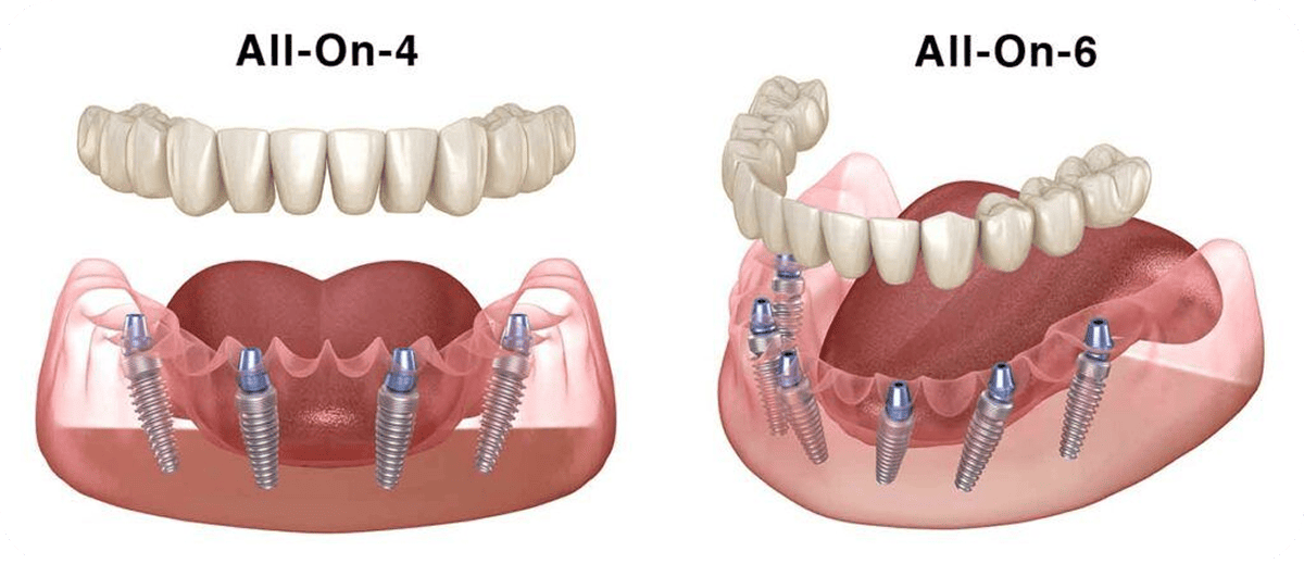 Implant dentar VivoDent